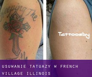 Usuwanie tatuaży w French Village (Illinois)