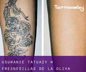 Usuwanie tatuaży w Fresnedillas de la Oliva