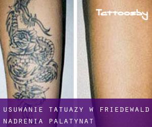 Usuwanie tatuaży w Friedewald (Nadrenia-Palatynat)