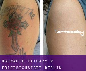 Usuwanie tatuaży w Friedrichstadt (Berlin)