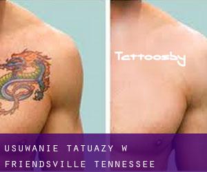 Usuwanie tatuaży w Friendsville (Tennessee)