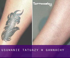 Usuwanie tatuaży w Gannachy