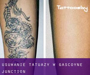 Usuwanie tatuaży w Gascoyne Junction