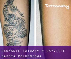 Usuwanie tatuaży w Gayville (Dakota Południowa)