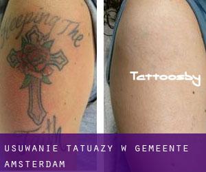 Usuwanie tatuaży w Gemeente Amsterdam