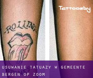 Usuwanie tatuaży w Gemeente Bergen op Zoom