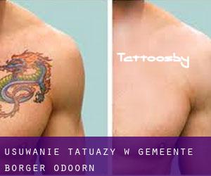 Usuwanie tatuaży w Gemeente Borger-Odoorn