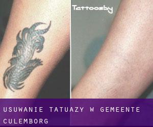 Usuwanie tatuaży w Gemeente Culemborg