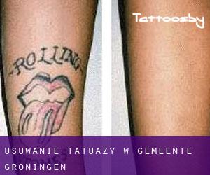 Usuwanie tatuaży w Gemeente Groningen