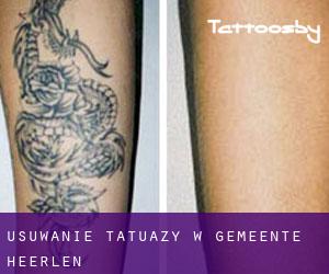 Usuwanie tatuaży w Gemeente Heerlen
