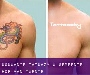 Usuwanie tatuaży w Gemeente Hof van Twente