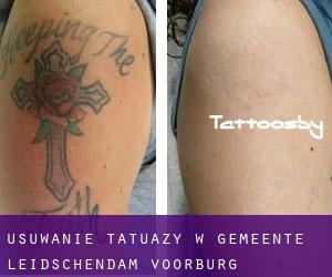 Usuwanie tatuaży w Gemeente Leidschendam-Voorburg