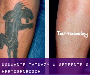 Usuwanie tatuaży w Gemeente 's-Hertogenbosch