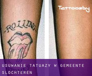 Usuwanie tatuaży w Gemeente Slochteren