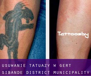 Usuwanie tatuaży w Gert Sibande District Municipality