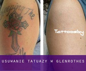Usuwanie tatuaży w Glenrothes
