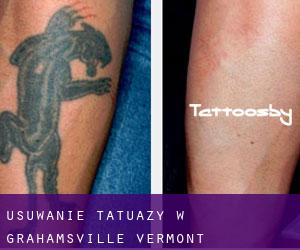 Usuwanie tatuaży w Grahamsville (Vermont)