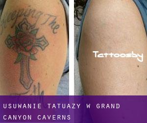 Usuwanie tatuaży w Grand Canyon Caverns
