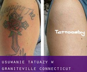 Usuwanie tatuaży w Graniteville (Connecticut)