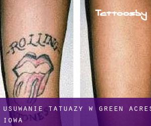 Usuwanie tatuaży w Green Acres (Iowa)