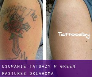 Usuwanie tatuaży w Green Pastures (Oklahoma)