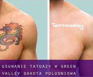 Usuwanie tatuaży w Green Valley (Dakota Południowa)