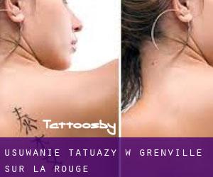 Usuwanie tatuaży w Grenville-sur-la-Rouge