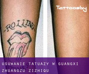 Usuwanie tatuaży w Guangxi Zhuangzu Zizhiqu