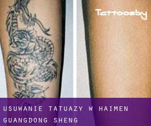 Usuwanie tatuaży w Haimen (Guangdong Sheng)