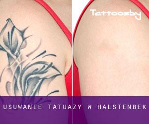 Usuwanie tatuaży w Halstenbek