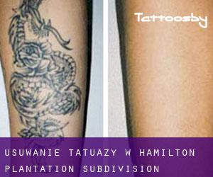 Usuwanie tatuaży w Hamilton Plantation Subdivision