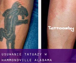 Usuwanie tatuaży w Hammondville (Alabama)