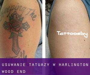 Usuwanie tatuaży w Harlington Wood End