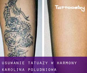 Usuwanie tatuaży w Harmony (Karolina Południowa)