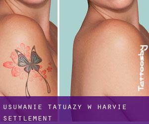 Usuwanie tatuaży w Harvie Settlement