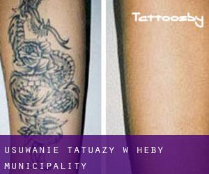 Usuwanie tatuaży w Heby Municipality