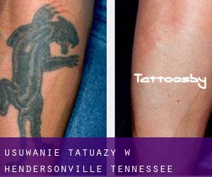 Usuwanie tatuaży w Hendersonville (Tennessee)