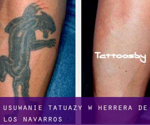 Usuwanie tatuaży w Herrera de los Navarros
