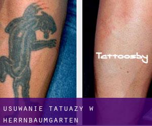 Usuwanie tatuaży w Herrnbaumgarten