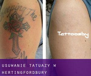 Usuwanie tatuaży w Hertingfordbury