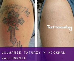 Usuwanie tatuaży w Hickman (Kalifornia)