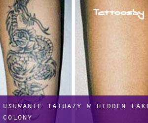 Usuwanie tatuaży w Hidden Lake Colony
