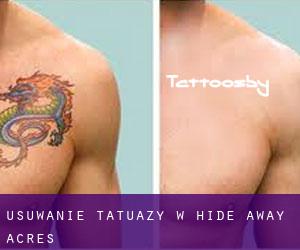 Usuwanie tatuaży w Hide Away Acres