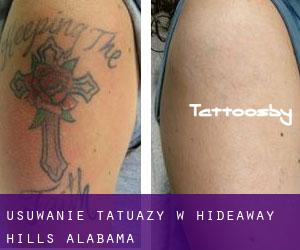 Usuwanie tatuaży w Hideaway Hills (Alabama)