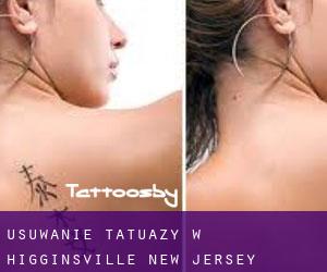 Usuwanie tatuaży w Higginsville (New Jersey)