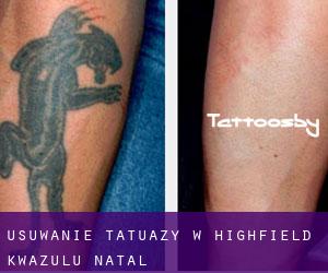 Usuwanie tatuaży w Highfield (KwaZulu-Natal)