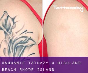 Usuwanie tatuaży w Highland Beach (Rhode Island)