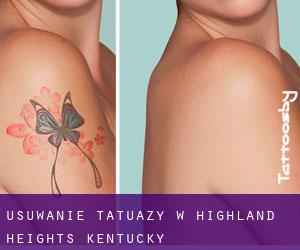 Usuwanie tatuaży w Highland Heights (Kentucky)