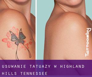 Usuwanie tatuaży w Highland Hills (Tennessee)