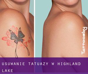 Usuwanie tatuaży w Highland Lake
